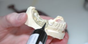 Pourquoi opter pour des prothèses dentaires ?